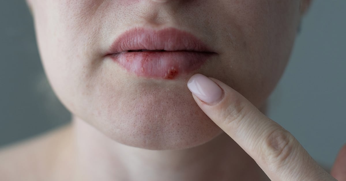 Un ladrón silencioso que dejó sin respuestas a un trasplante de médula: la pastilla que promete destrabar al herpes resistente