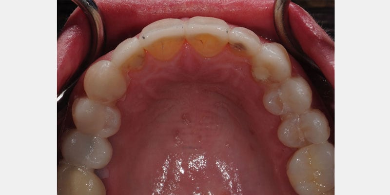 Carillas dentales: la filtración que empieza en el borde y puede comprometer el diente